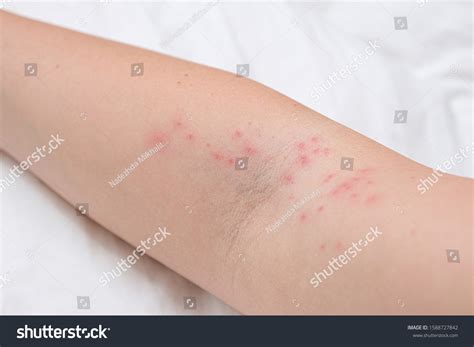 Skin Rash On Female Arm Itchy Stock Photo 1588727842 Shutterstock