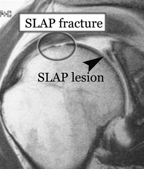 Slap Lesions Or Superior Labral Anterior Posterior Lesions Are Tears Of