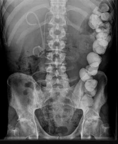 Abdominal Radiograph Taken Three Days Post Ercp Shows That The Contrast