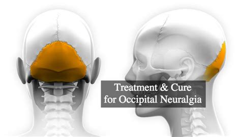 Treatment And Cure For Occipital Neuralgia