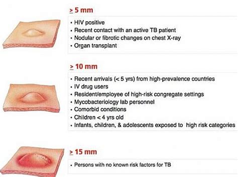 Tuberculin Skin Test Positive Mantoux Test Result Grepmed