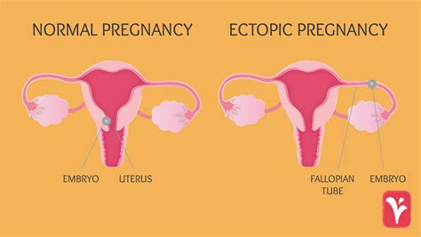 Ectopic Pregnancies What You Need To Know Austin Womens Health Center