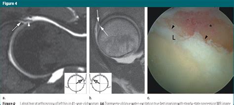 Mr Arthrography Of The Hip Differentiation Between An Anterior