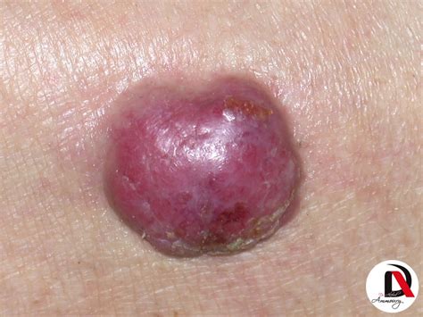 Merkel cell carcinoma occurs when these cells begin to grow uncontrollably. Merkel Cell Carcinoma - Dr. ALFRED AMMOURY