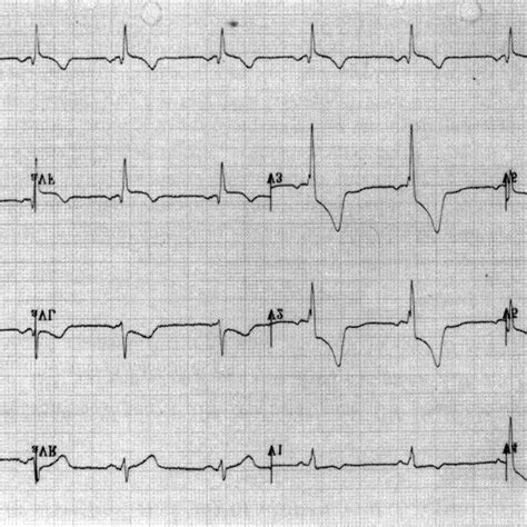 Electrocardiogram Shows The Old Anterior Myocardial Infarction Seven