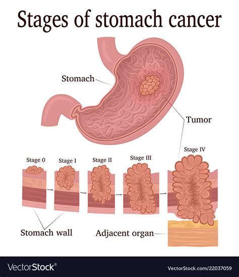 Stages Of Stomach Cancer Royalty Free Vector Image