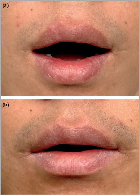 Figure 1 From Treatment Of Fordyce Spots With 5 Aminolaevulinic Acid