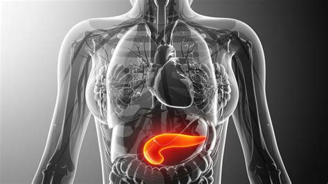 Pancreatic cancer can be treated if caught early, but signs are often subtle, it is usually missed at first. Cáncer de páncreas: ¿Cuáles son los síntomas y factores de ...