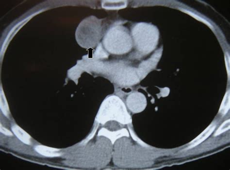 Video Assisted Thoracoscopic Vats Thymectomy Ctsnet