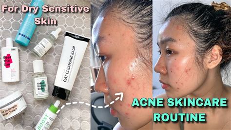 acne morning skincare routine for dry sensitive acne prone skin fast results shown youtube