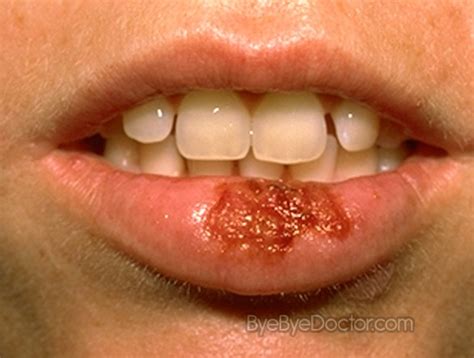 Herpes on your tongue is just that: Oral Herpes - Symptoms, Pictures, Causes, Treatment