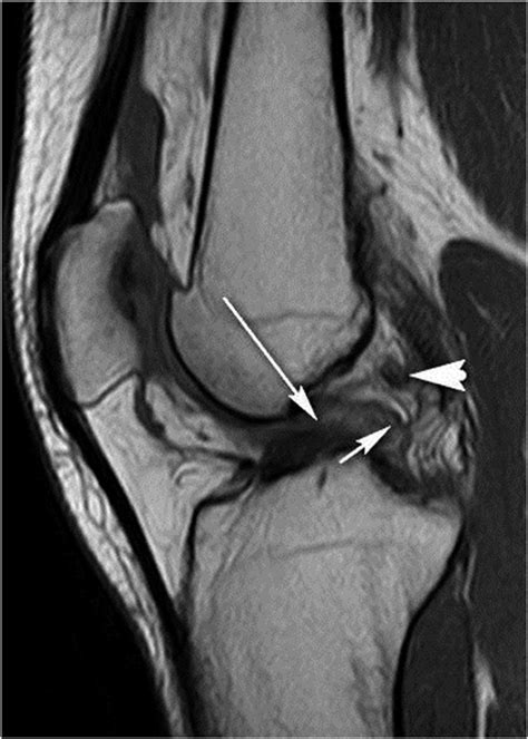 A Twenty Nine Year Old Woman With A Twisting Injury To The Right Knee