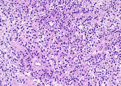Mucoepidermoid Carcinoma Of Parotid Gland
