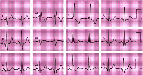 1. Elektrokardiogram (EKG)