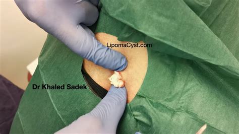 Cyst Removal From Back Lipomacyst Com Dr Khaled Sadek Youtube