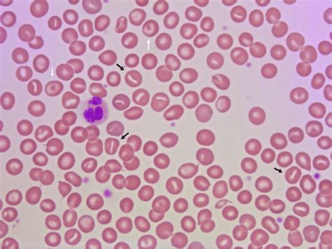 Peripheral Blood Smear From A Patient With Dehydrated