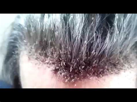 NOPE Video Of This Guy's Head Lice Infestation Will Make ...