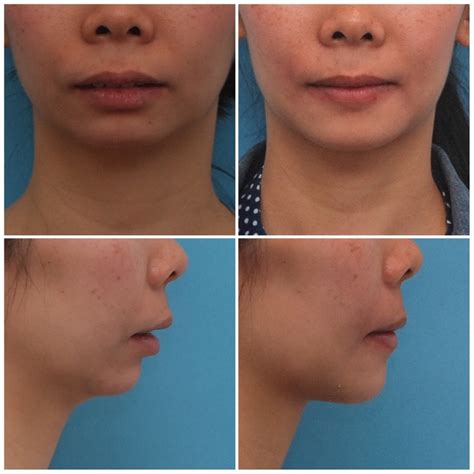 Chin Lengthening Sliding Genioplasty Dr Majid Jamali