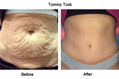 Understanding Tummy Tuck Surgery Abdominoplasty Types Recovery