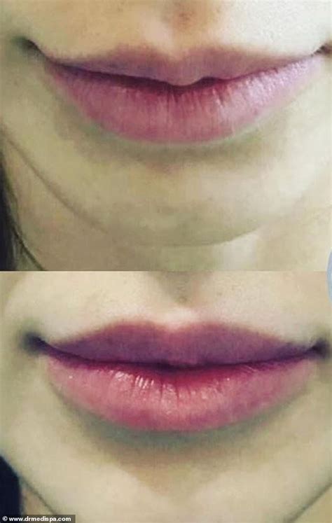 Check spelling or type a new query. Lip 'threading' is the trend tipped to take over fillers ...