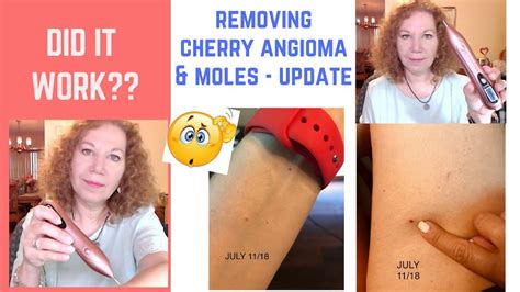 Update Video Did It Work Burning Off Cherry Angioma Skin Tags Real Expectations Youtube