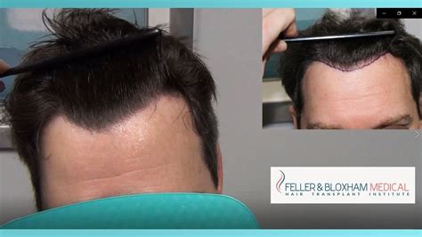 How to fix a cowlick guys. A Surprising Hair Transplant: Scar Repair, Hairline Fix ...
