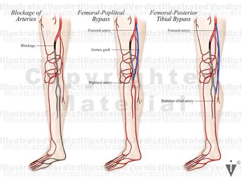 Stock Lower Limb Bypass Of Vasculature — Illustrated Verdict