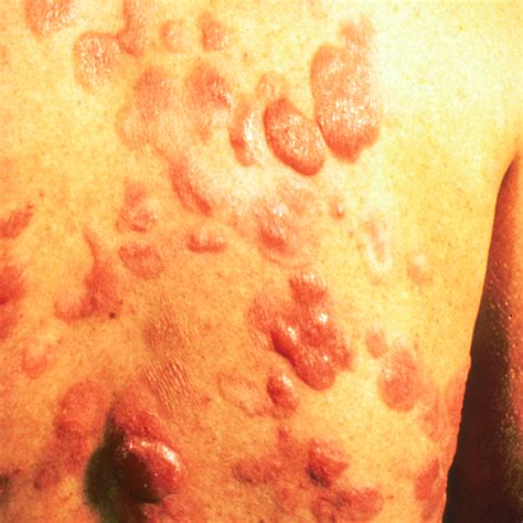 Skin Cancer Images Types Of Skin Cancer