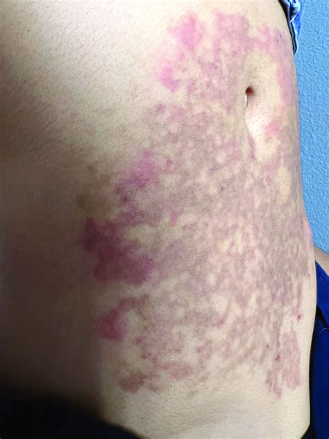 A White Female Presented With Pruritic Reticulated Erythematous Plaques On The Abdomen