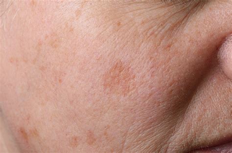 Brown Spots On Your Skin