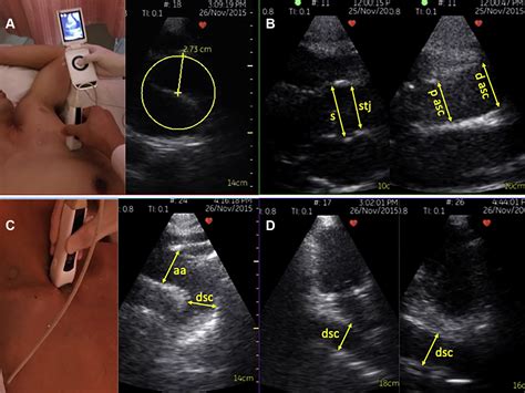 Pocket Size Mobile Echocardiographic Screening Of Thoracic Aortic