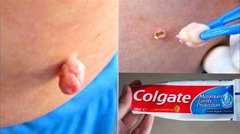 When it comes to crawlspaces, you can use thick plastic sheets on the floor as a proactive measure to keep. Home Remedies for Skin Tag Removal | Home remedies for skin