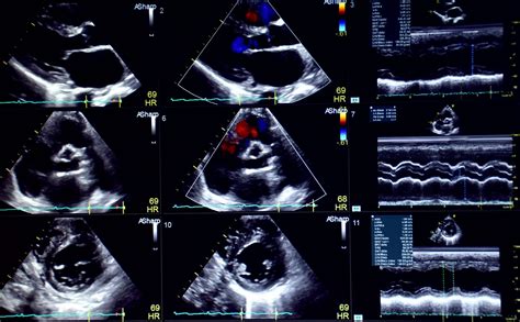 Echocardiogram Hollywood Diagnostics