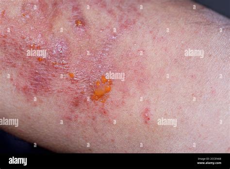 Eczema High Resolution Stock Photography And Images Alamy