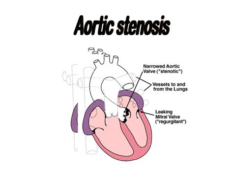 Ppt Aortic Stenosis Powerpoint Presentation Free Download Id3493665