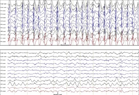 Human Electroencephalograms Eeg Common Reference Leads Before