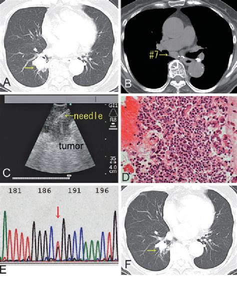 Figure 1 From Successful Treatment Of Lung Cancer With Gefitinib And