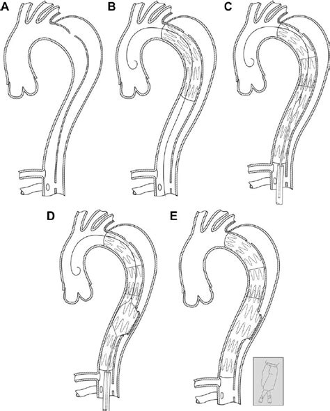 Illustration Of The Knickerbocker Technique In A A Type B Aortic