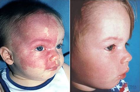 Port Wine Stain Birthmark Removaltreatment Cost Causes Pictures