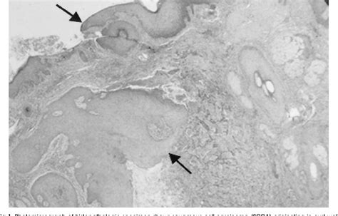 Figure 1 From Squamous Cell Carcinoma In An Epidermal Inclusion Cyst