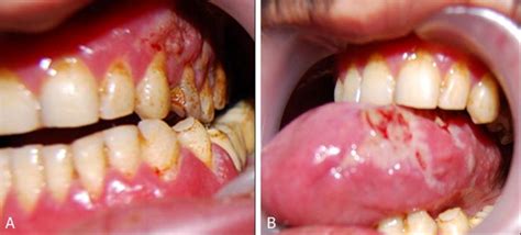 A Edematous And Erythematous Gingiva With Velvety Surface And Areas