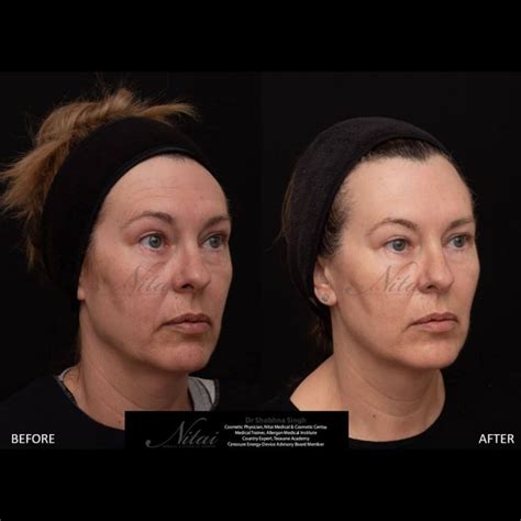 Jowl Treatment With Dermal Fillers Melbourne Nitai Clinic