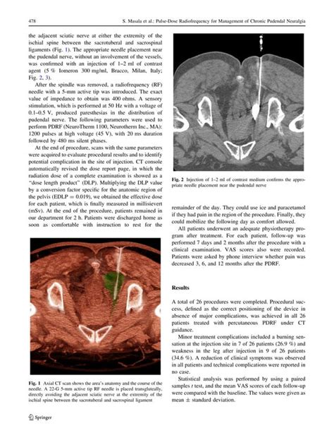 Ct Guided Percutaneous Pulse Dose Radiofrequency For Pudendal Neuralgia