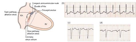 Catheter ablation effectiveness rates exceed 88 percent for atrioventricular nodal reentrant tachycardia, atrioventricular reciprocating tachycardia, and atrial flutter; Atrioventricular nodal re-entrant tachycardia | Thoracic Key