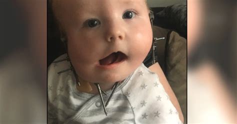 Baby Boy With No Jaw Undergoes Facial Operation Thats 1st Of Its Kind