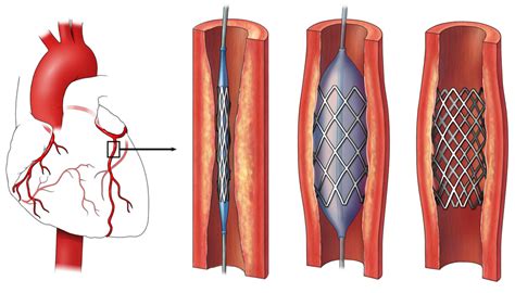 Stents What To Expect When Getting A Stent Nhlbi Nih