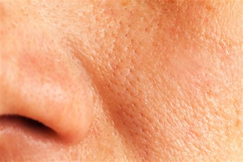How To Get Rid Of Enlarged Pores Naturally At Home
