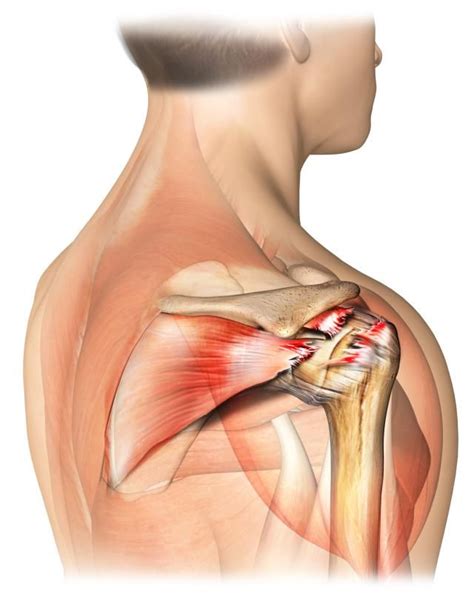 Is Your Shoulder Pain From Your Rotator Cuff Rotator Cuff Rotator