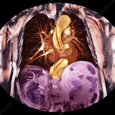 Aortic Dissection Imaging Images