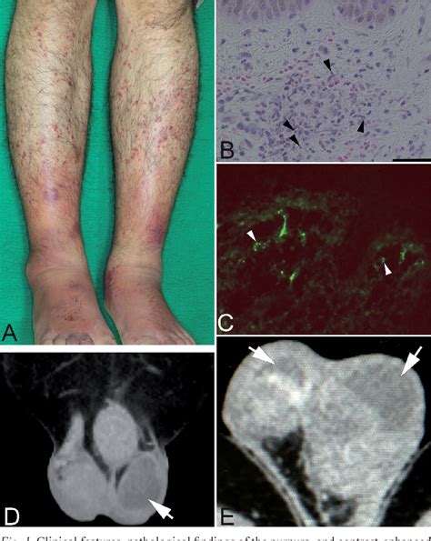 Figure 1 From Immunoglobulin A Iga Vasculitis Also Known As